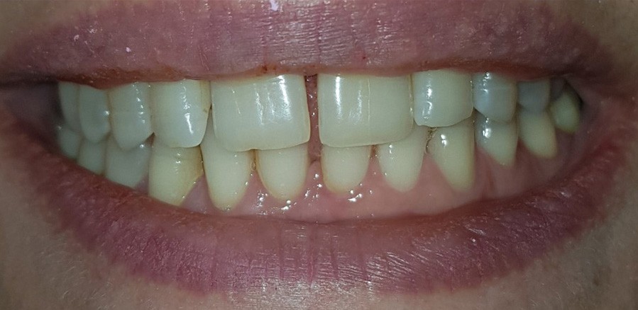 بعد تبيض-ليزر 3